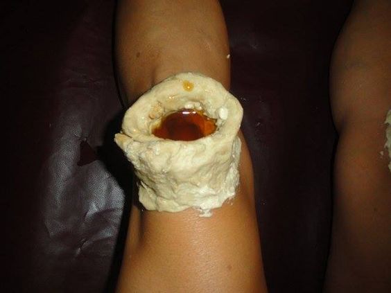 Janu Basti Ayurvedic knee treatment explained by Art of Vedas - warm medicated oil held on the knee joint with dough ring for pain relief